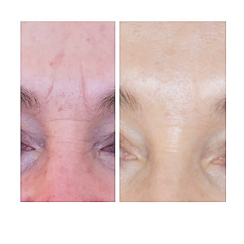 Frown line - Wrinkle relaxing injections and a little Dermal filler to smooth